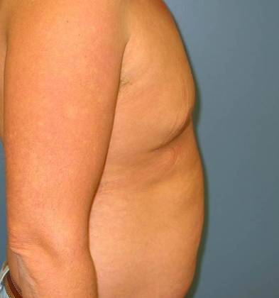After Image: Gynecomastia: Case 2 - right-side
