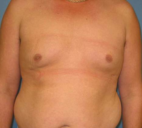 After Image: Gynecomastia: Case 2 - front