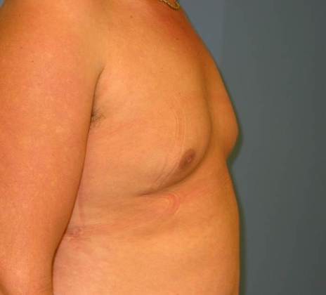 After Image: Gynecomastia: Case 2 - right-side