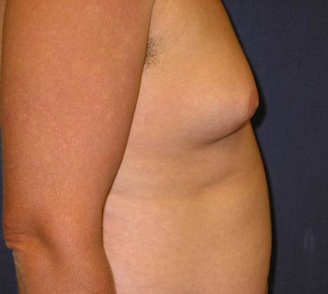 Before Image: Gynecomastia: Case 2 - right-side
