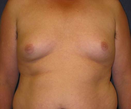 Before Image: Gynecomastia: Case 2 - front