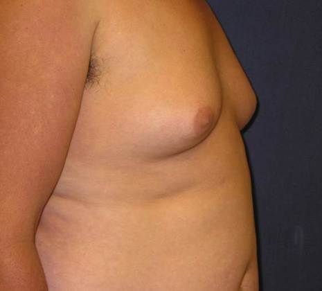 Before Image: Gynecomastia: Case 2 - right-side