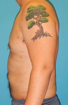 After Image: Gynecomastia: Case 3 - left-side