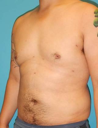 After Image: Gynecomastia: Case 3 - left-front-oblique