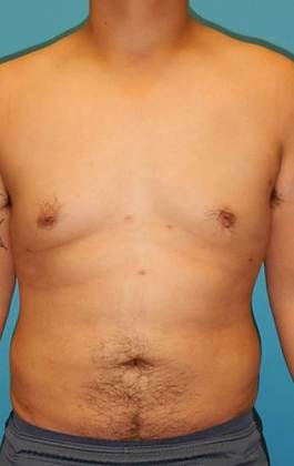 After Image: Gynecomastia: Case 3 - front