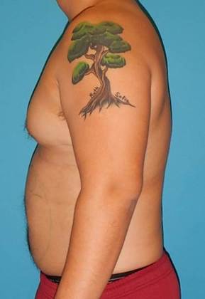Before Image: Gynecomastia: Case 3 - left-side