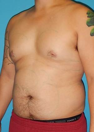 Before Image: Gynecomastia: Case 3 - left-front-oblique