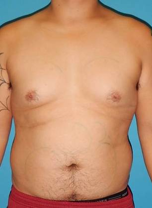 Before Image: Gynecomastia: Case 3 - front