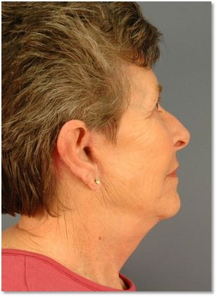 After Image: Neck Lift: Case 2 - right-side