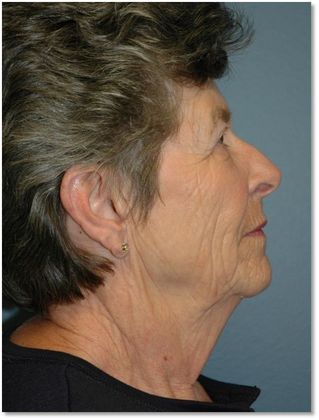 Before Image: Neck Lift: Case 2 - right-side