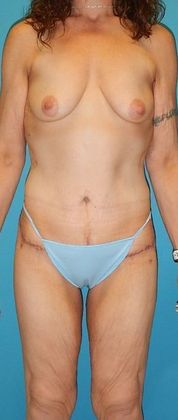 After Image: Body Lifts: Case 2 - front
