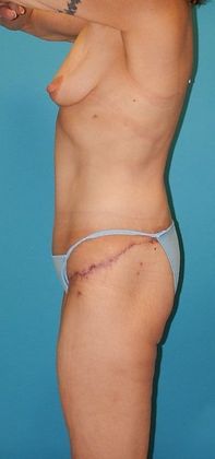 After Image: Body Lifts: Case 2 - left-side