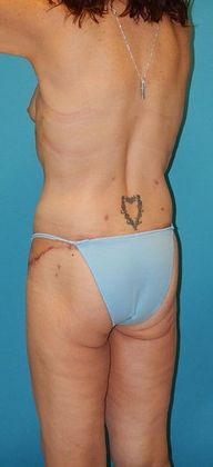 After Image: Body Lifts: Case 2 - left-back-oblique