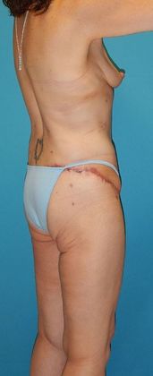 After Image: Body Lifts: Case 2 - right-back-oblique