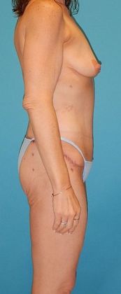 After Image: Body Lifts: Case 2 - right-side