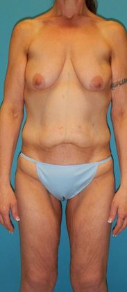Before Image: Body Lifts: Case 2 - front
