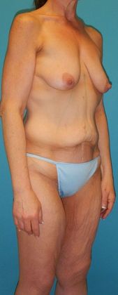 Before Image: Body Lifts: Case 2 - right-front-oblique
