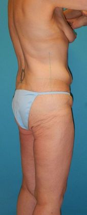 Before Image: Body Lifts: Case 2 - right-back-oblique