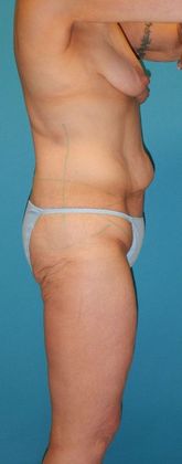 Before Image: Body Lifts: Case 2 - right-side