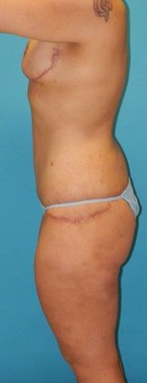 After Image: Mommy Makeover: Case 2 - left-side