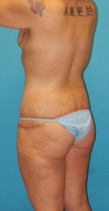 After Image: Mommy Makeover: Case 2 - left-back-oblique