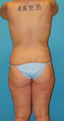 After Image: Mommy Makeover: Case 2 - back