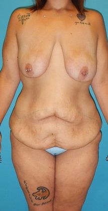 Before Image: Mommy Makeover: Case 2 - front
