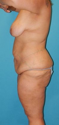 Before Image: Mommy Makeover: Case 2 - left-side