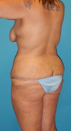Before Image: Mommy Makeover: Case 2 - left-back-oblique