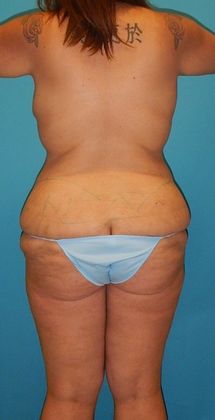 Before Image: Mommy Makeover: Case 2 - back