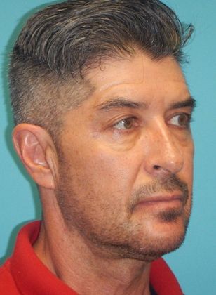 After Image: Chin Augmentation: Case 2 - right-front-oblique
