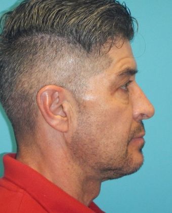 After Image: Chin Augmentation: Case 2 - right-side