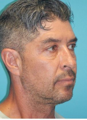Before Image: Chin Augmentation: Case 2 - right-front-oblique