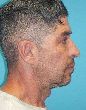 Before Image: Chin Augmentation: Case 2 - right-side