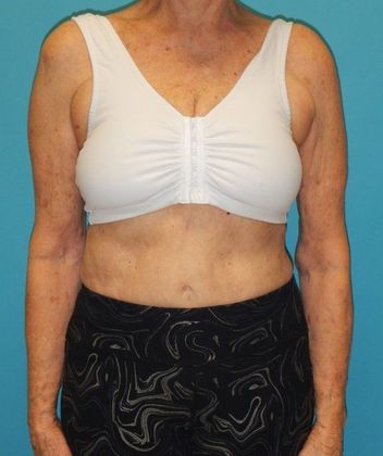 After Image: Arm Lift: Case 2 - front