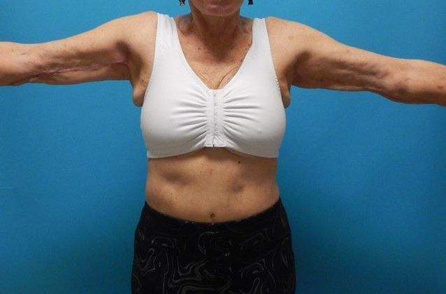 After Image: Arm Lift: Case 2 - front