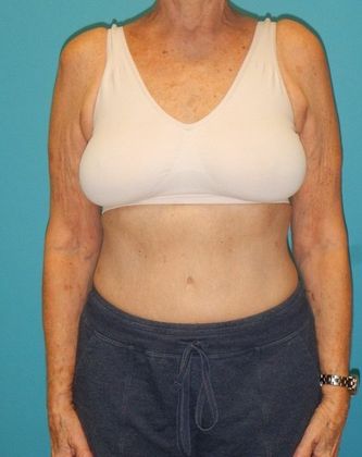 Before Image: Arm Lift: Case 2 - front