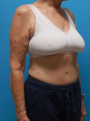 Before Image: Arm Lift: Case 2 - right-front-oblique