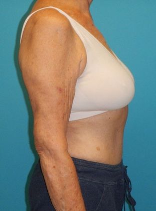 Before Image: Arm Lift: Case 2 - right-side