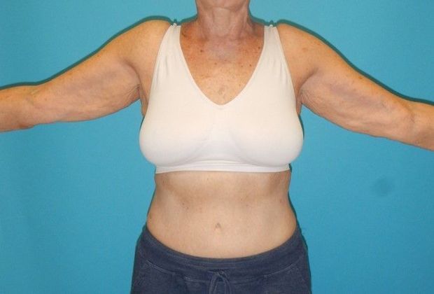 Before Image: Arm Lift: Case 2 - front