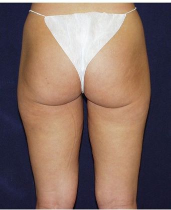 After Image: Liposuction: Case 2 - back