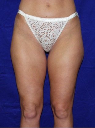Before Image: Liposuction: Case 2 - front