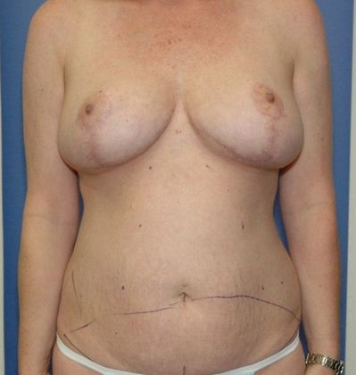 After Image: Breast Reduction: Case 2 - front