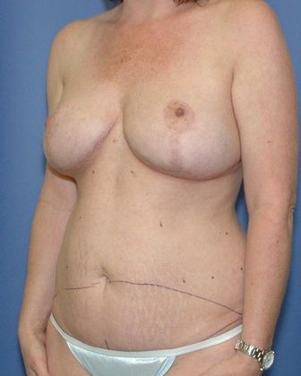 After Image: Breast Reduction: Case 2 - left-front-oblique
