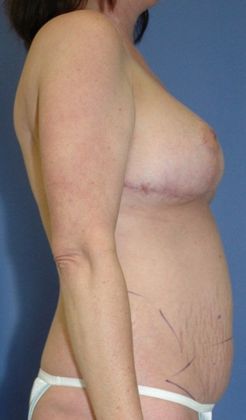 After Image: Breast Reduction: Case 2 - right-side
