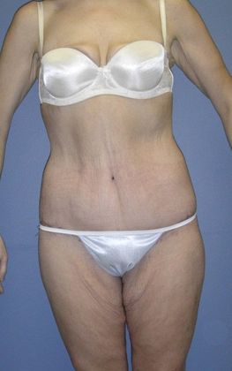 After Image: Abdominoplasty: Case 2 - front