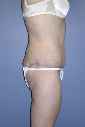 After Image: Abdominoplasty: Case 2 - right-side
