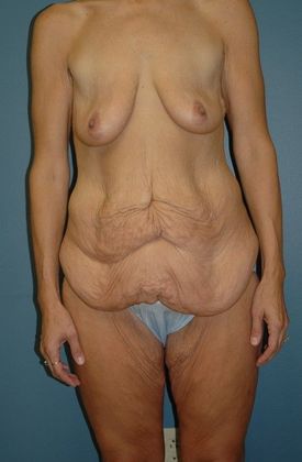 Before Image: Abdominoplasty: Case 2 - front