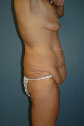 Before Image: Abdominoplasty: Case 2 - right-side