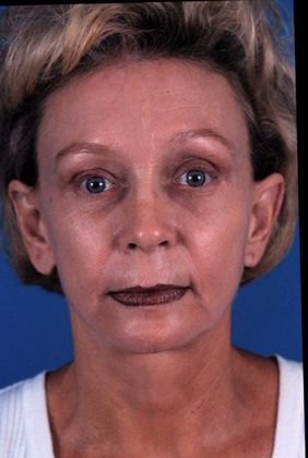After Image: Brow Lift: Case 2 - front